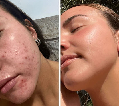 Red Light Mask | LED Face Mask | Skin Light Therapy | SkinGlow