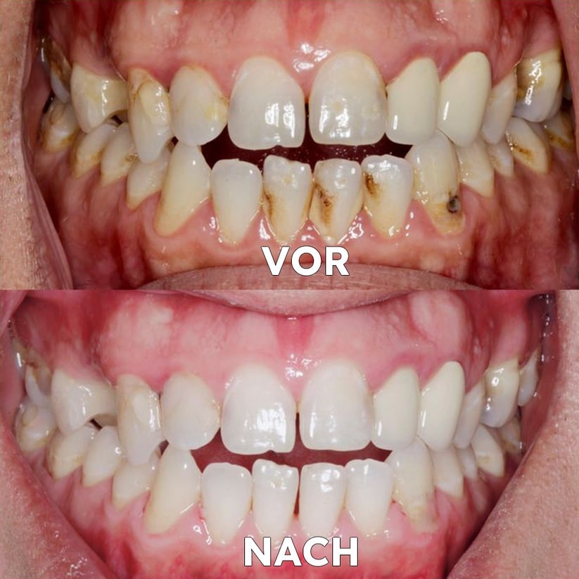 Mineral Powder for Dental Care | Strengthen & Protect Teeth | SmileProtection